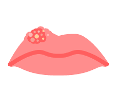 Cold Sore